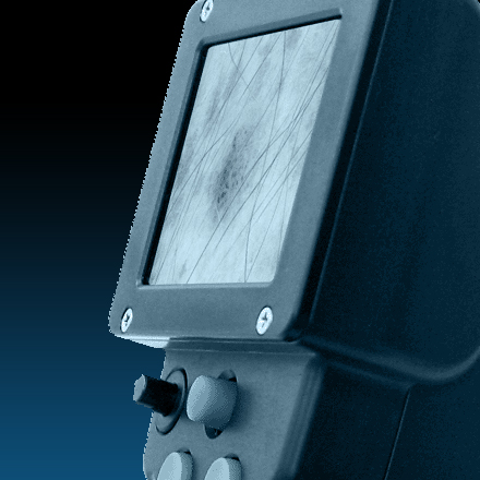 MoleMax HD Camera LCD